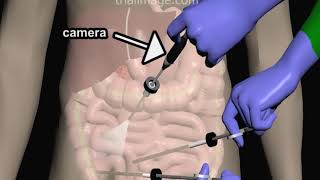 Laparoscopic Appendectomy  Animation by Cal Shipley MD [upl. by Euqinomahs827]