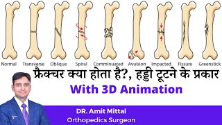 Common types of Bone fracture  Types of Fracture in Hindi  Bones Fracture [upl. by Inanaup]