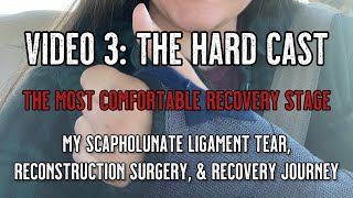 Scapholunate Ligament Tear and Reconstruction  Video 3 hard cast update [upl. by Simone]