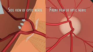 What are the nerve fibers as it relates to glaucoma [upl. by Sirehc]