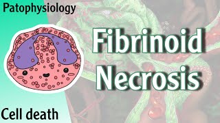 Pathophysiology  Fibrinoid Necrosis Hani Laith شرح [upl. by Musihc]