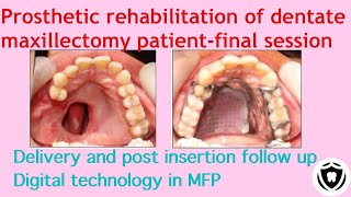 prosthetic rehabilitation of dentate maxillectomy patient  final session [upl. by Tsnre]