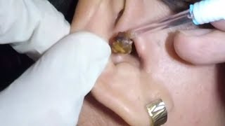 Womans Massive Earwax Removal in Both Ears [upl. by Meggy]