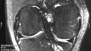 Ligamentoplastiecroiseanterieurnormale IRM 3D [upl. by Valli]