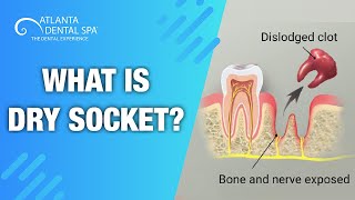 What is Dry Socket Top dentist says how to Prevent It  Atlanta Dental Spa 2019 [upl. by Ahsienaj]