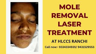 Mole Removal Laser Treatment at Hlccs RanchiCall now 9334334935 moleremoval hlccsranchi [upl. by Noman]