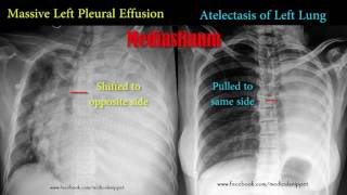 pleural effusion vs atelectasis [upl. by Pebrook238]