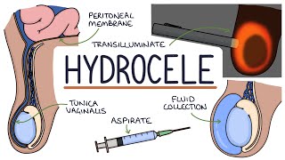 Understanding Hydroceles [upl. by Horick884]