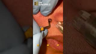 Mole Removal Treatment at DrKasanas Clinic [upl. by Kearney600]