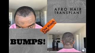 Black Hair Transplant at Cosmedica  Bumps bumps bumps  One Month Update [upl. by Acinaj]