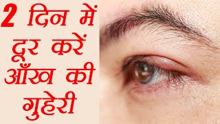 आंख की गुहेरी दूर करने के घरेलु उपाय  How to get rid of a Stye  Eye Care  Hordeolum  Boldsky [upl. by Viridi]