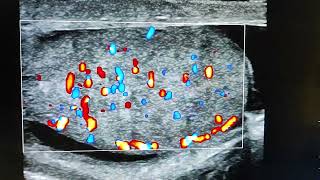 acute epididymoorchitis Tauhid ultrasonography Cumilla [upl. by Nnaesor518]