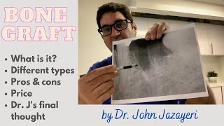 Bone Graft What is it Pros amp Cons  Different Types [upl. by Ylellan]