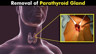 How Parathyroid Gland Surgery Is Performed UrduHindi [upl. by Wall614]