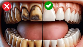 9 Natural Ways To Remove Plaque And Tartar From Your Teeth [upl. by Aurel]