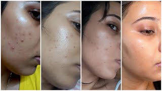 My Honest Affordable morning skincare Routine to remove pimples amp pimple marks non sponsored [upl. by Salomi589]