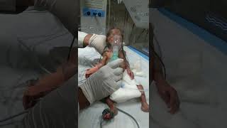 newborn baby preturm and pneumonia and nebulizer baby baby doctor nurshing shortsvideo shorts [upl. by Helbonnah]