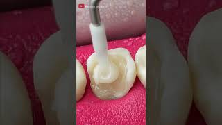 Unbelievable Tooth Restoration asmr restoration [upl. by Aria7]