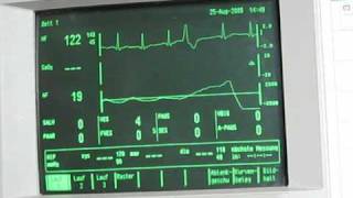 cardiac arrhythmia EKG [upl. by Sivle]