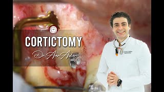 Corticotomy of impacted canine in orthodontics [upl. by Carrelli]