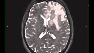 Grade 3 Anaplastic Astrocytoma [upl. by Hannon979]