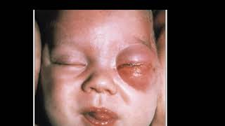 Case 654 How to approach for preorbital Orbital cellulitiscefotaxime Oxacillin cefotrixone  van [upl. by Akela808]