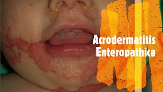 Acrodermatitis enteropathica [upl. by Jasper352]