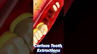 Immediate Implant Placement After Tooth Extraction [upl. by Tremayne]