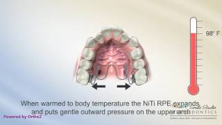 NiTi Palatal Expander  Orthodontics [upl. by Orelie]