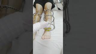 Man From USA Undergoing Height Increase Surgery limblengthening height heightsurgery LON [upl. by Aziram]