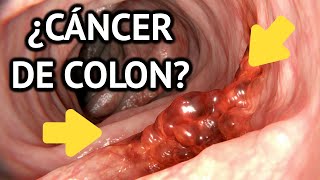 Cáncer de estómago Quien esta en riesgo y cuales son los sintomas [upl. by Notyalc118]