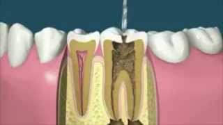 How to Do Root Canal Treatment [upl. by Eusadnilem]