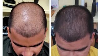 wow best hair regrowth by Dr Danish Chauhan hairfall baldness hairregrowth gfctreatment [upl. by Valtin]