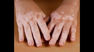 Best home remedies for vitiligo leucoderma [upl. by Anemaj163]