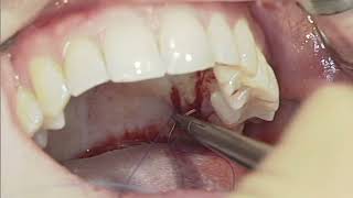 Treatment of mandibular gingival recession with a tunnel by Prof Anton Sculean [upl. by Wiltsey]