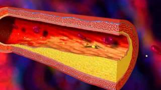 videoaboutcomThrombosis  What Is Thrombosis  Dangers of Arterial Plaque Videomp4 [upl. by Allx231]