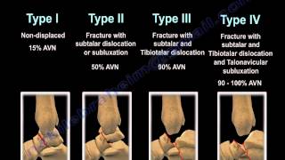 Talus Fracture Types  Everything You Need To Know  Dr Nabil Ebraheim [upl. by Kin737]