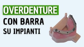 BARRA su Impianti dentali per OVERDENTURE [upl. by Gertie]