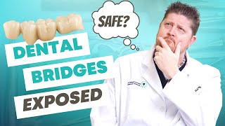 5 Things You Didnt Know About Dental Bridges but should [upl. by Nivan555]