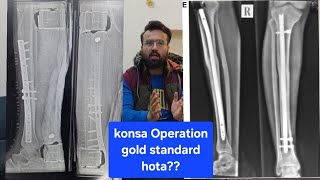 Rod ya plateleg ke fracture me konsa operation Best hota bandaenaik [upl. by Odlonyer]