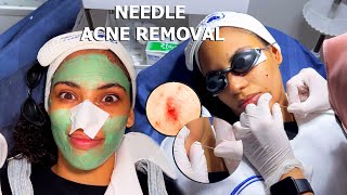 ASMR I Tried ACNE REMOVAL with NEEDLES [upl. by Gorrono56]