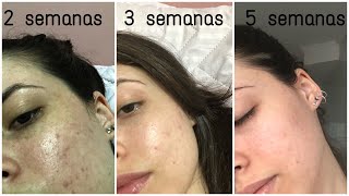 TRATANDO ACNE  Minha experiência com ADAPALENO [upl. by Thgirw]