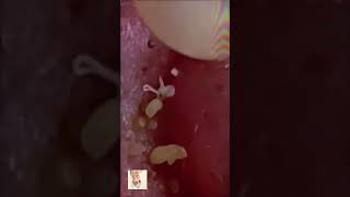 Blackheads Removal  Acne Treatment and Very Satisfying Satisfying Pimple pop blackheads [upl. by Vesta965]