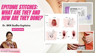 Epitome Stitches What Are They and How Are They Done – Dr BKN Sudha’s Detailed Guide [upl. by Efar289]