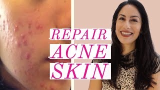 How to REPAIR Acne Prone Skin » Ingredients YOU NEED [upl. by Ahsak]