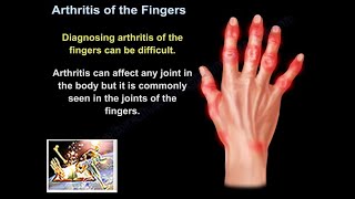 Arthritis Of The Fingers  Everything You Need To Know  Dr Nabil Ebraheim [upl. by Eri446]