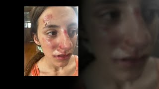 Girl 13 says she was bullied beaten at school in Gardner Illinois  ABC7 Chicago [upl. by Anauq]