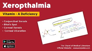 Xerophthalmia  Vitamin A deficiency  WHO Classification [upl. by Tibbetts]