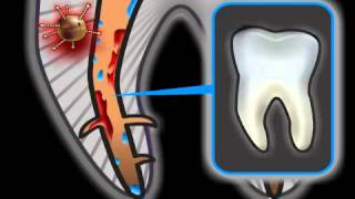 Root Canal Complications in Dentistry [upl. by Pitchford534]