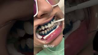 teeth whitening process 🦷 torontoteethwhitening teethwhitening [upl. by Alfeus]